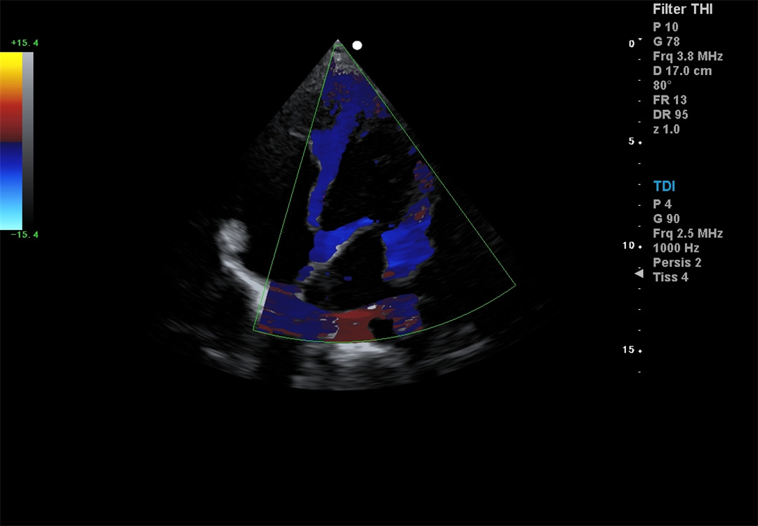 Color Doppler imaging (2)